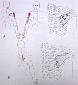 Dry Needling