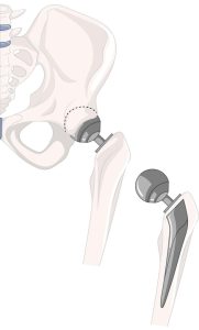 totale heup prothese